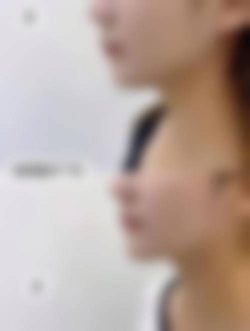 艾莉薇传奇玻尿酸价格