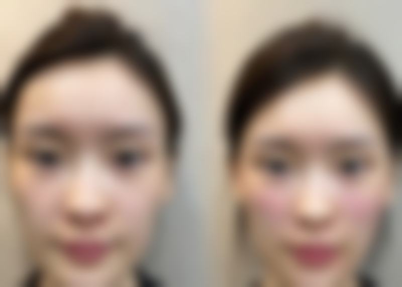 大连爱德丽格医美伊婉 1ml 玻尿酸除皱项目实例/口碑