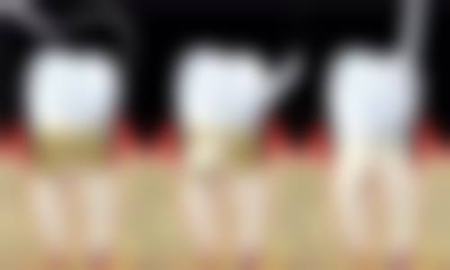 如何选择适合自己的种植牙品牌