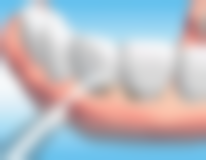 17岁牙齿矫正大概要花费多少钱