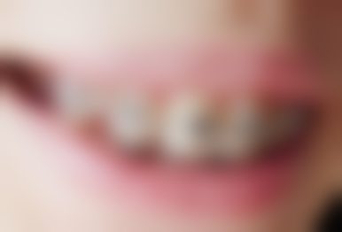 恒牙期（12岁后）治疗方案