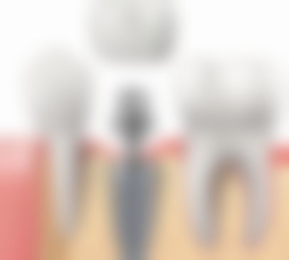 二十多岁进行牙齿矫正的必要性