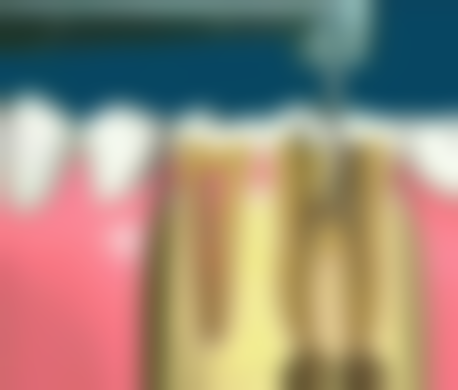 儿童能做根管治疗吗？权威解析告诉你，儿童根管治疗的安全性、适用性及治疗后效果有多好！ 