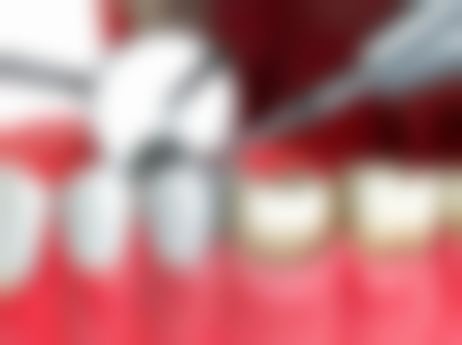 种植义齿中种植体与相邻的天然牙根至少应有的间隔是1.5mm以上