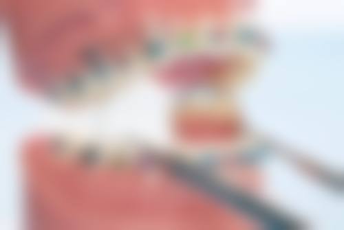 拔牙后不及时种牙的后果