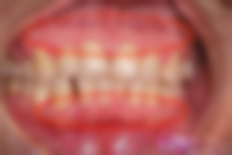 地包天牙齿矫正器要戴多长时间