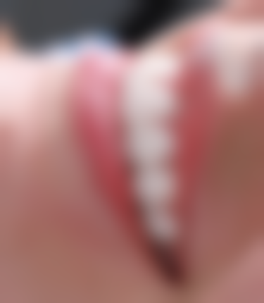 拔牙一年后再做种植牙的情况