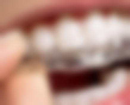 三十多岁地包天能做牙齿矫正吗?不过有几颗蛀牙