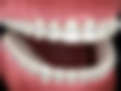 牙齿矫正器戴多久有成效