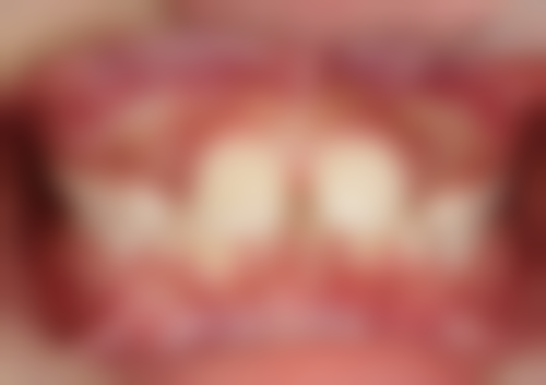 韩国纽百特种植牙怎么样