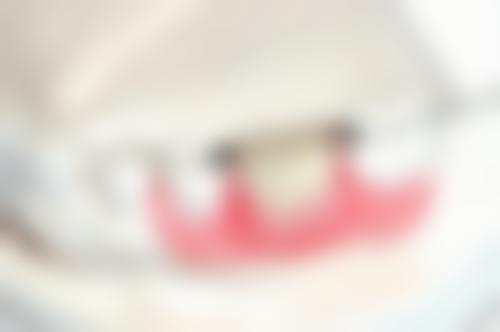 种植牙的利与弊、风险与危害