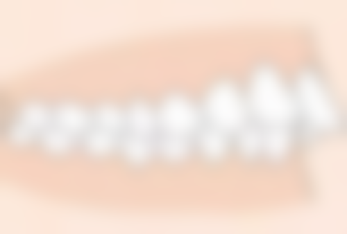 拔牙以后多久可以种植牙齿了？