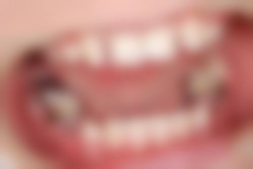 牙冠修复需要多久