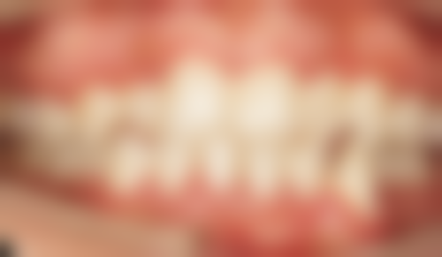 牙齿矫正需要拔牙吗？有什么危害