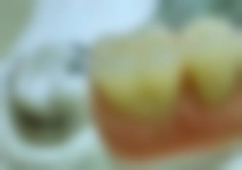 种植牙美国和韩国哪个好？深度剖析两国种植牙技术差异、价格对比及成功案例，为你选出更适合的方案！ 