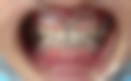 矫正牙齿需要多久