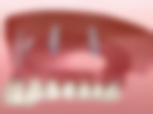 儿童地包天矫正要拍片吗？揭秘拍片对精准矫正的关键作用，为孩子口腔健康保驾护航！ 