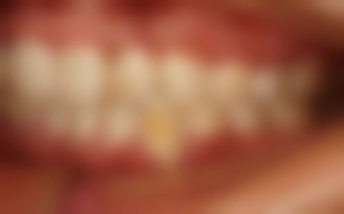 二十多岁了地包天如何纠正