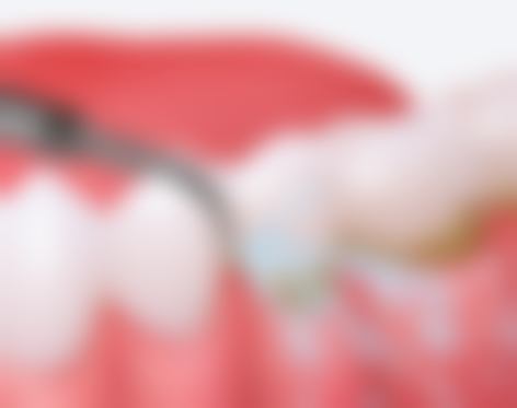 20岁地包天带牙套能矫正么