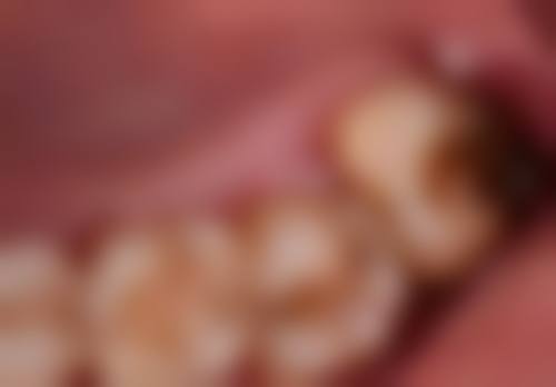 15岁地包天牙齿矫正晚吗？别担心，此时矫正正当时，了解关键时期优势，开启美观笑容新旅程！ 