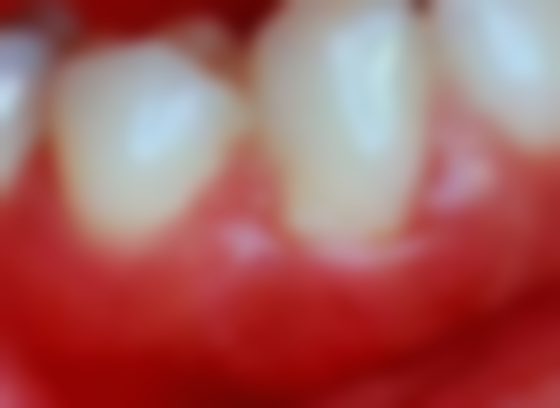 十五岁地包天矫正费用