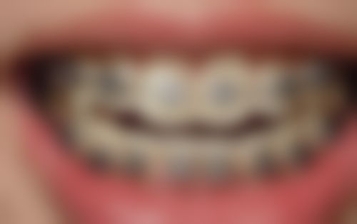 儿童补牙杀神经可以打麻药吗？