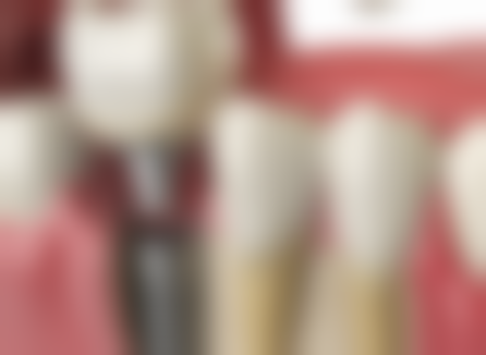 矫正牙齿需要多久