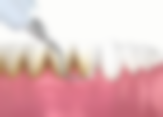 种植牙种植体植入后注意事项