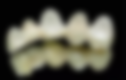 半口种植牙一次能种完吗？答案揭晓！一次种完优势多，能省时间还省钱，赶紧了解下！ 