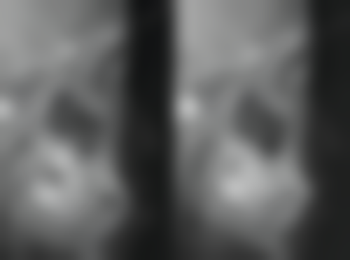 牙齿矫正牙齿松动怎么办呢？