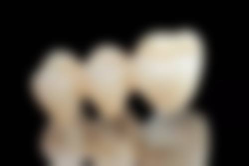 地包天矫正牙齿的至佳年龄