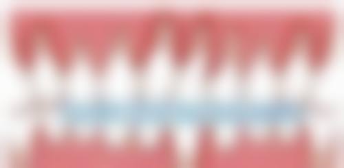 儿童地包天矫正反弹怎么办