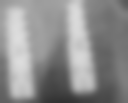 河南南阳方城万超口腔杨笑草医生种植牙实例与口碑