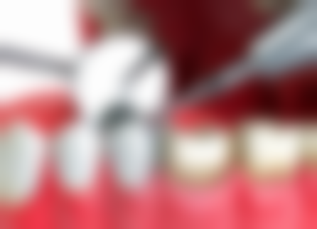 地包天矫正与脸型的关系