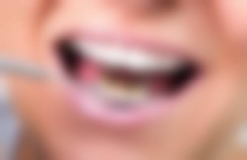 儿童换牙时代天使隐形矫