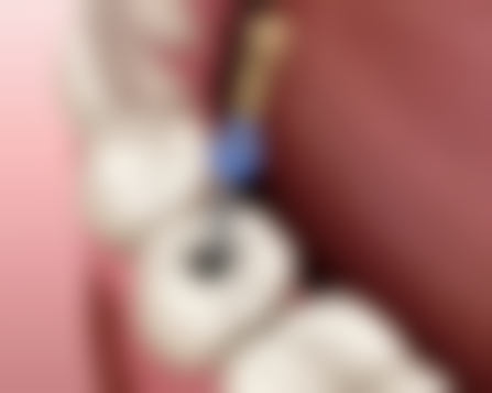 患儿男性3岁，乳前牙反覆牙合浅，反覆盖大，此时应选择