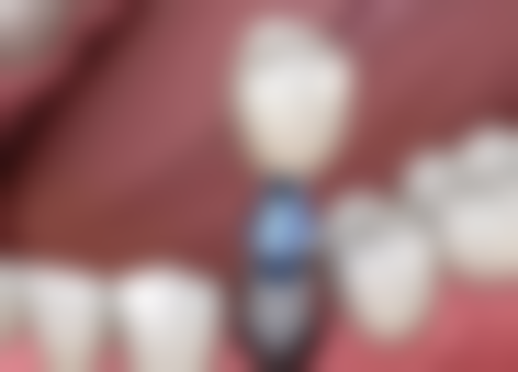 瑞典种植牙品牌astra怎么样？解密它的四大优势，让你种牙无忧，重拾自信笑容！ 