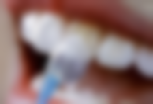 牙齿矫正多久需要调整一次