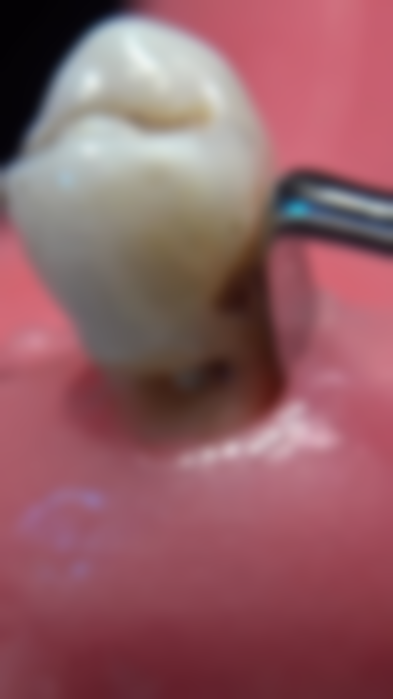 成人地包天矫正需要多少费用