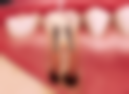 儿童补牙需要多长时间？了解影响时长因素，掌握3种加速补牙小妙招，让孩子快速拥有健康牙齿！ 