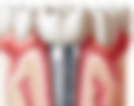 5岁可以矫正地包天吗？权威解析5岁矫正地包天的最佳时机、方法及显著优势！ 