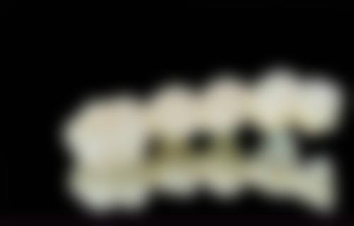 河南南阳方城万超口腔做牙冠399元起的实例/口碑