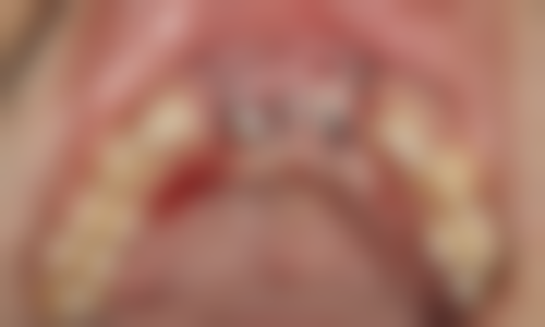 北京京大博爱口腔开展韩国SG种植牙项目的优势