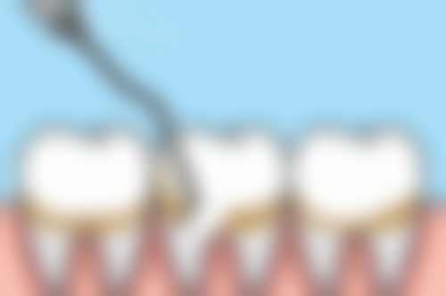 成人地包天快速矫正