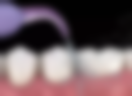 种植牙术后注意事项