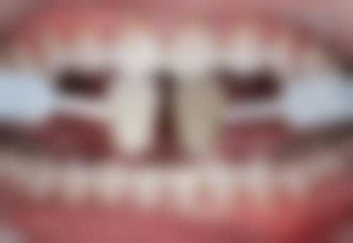 地包天牙齿好矫正吗