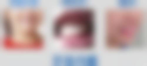 10岁矫正地包天分几个阶段?