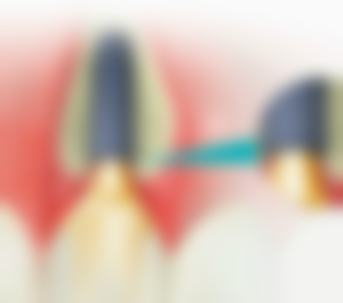 70岁以上的老人适合种植牙吗