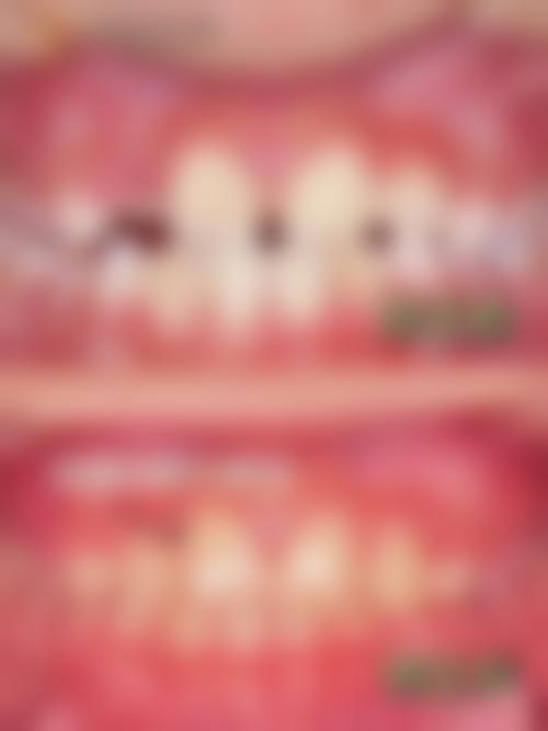 河南南阳方城万超口腔尹万洋医生牙齿矫正实例展示