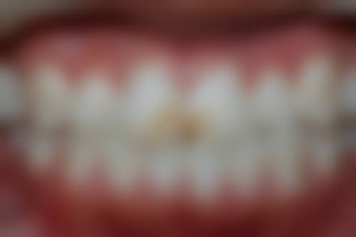 牙齿美白哪种方法好